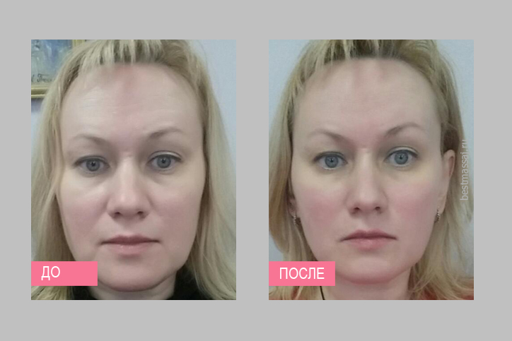 Лпджи массаж лица фото до и после